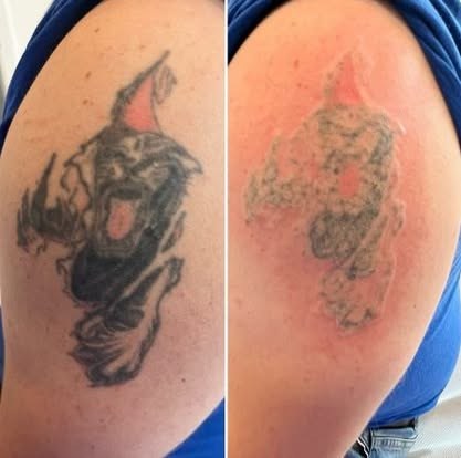 Tatuaż przed usuwaniem laserem i po pierwszym zabiegu